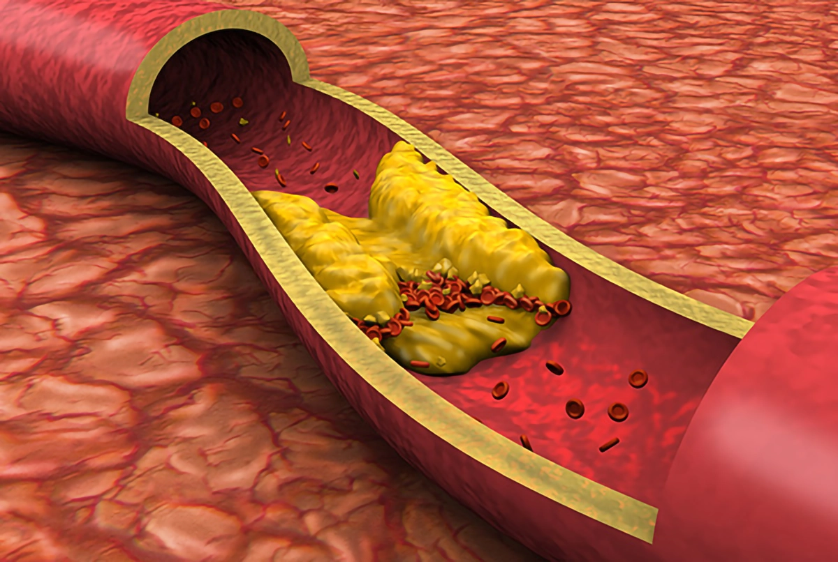 What is a Cholesterol? By Dr Muhammad Khan