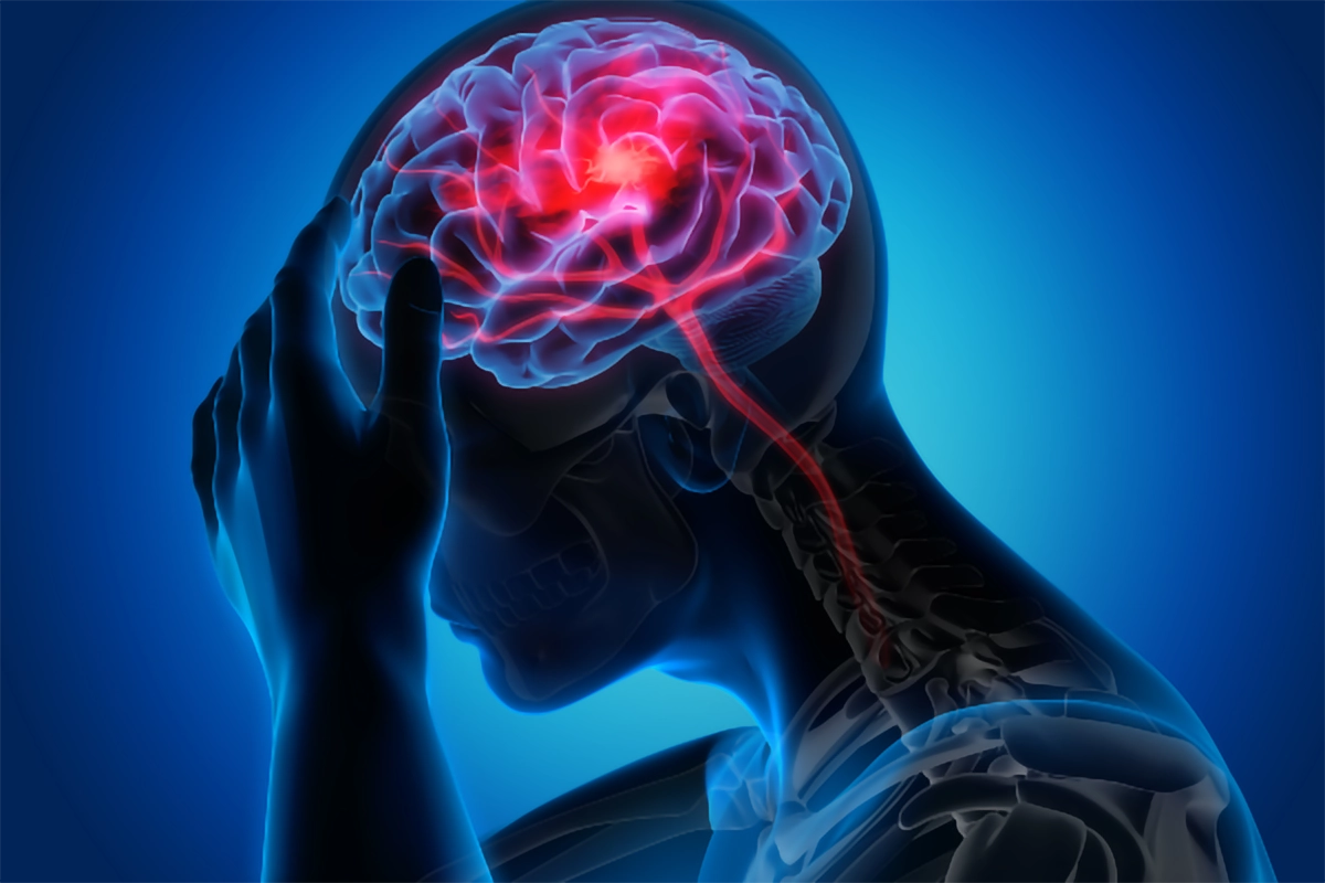 Stroke – Dr Ludmila Fjodorova
